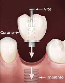 Dental Time Corona Dentale su Impianto Avvitata Cesano Maderno