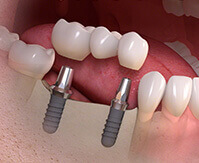 Dental Time Ponte Dentale 3Denti Cesano Maderno