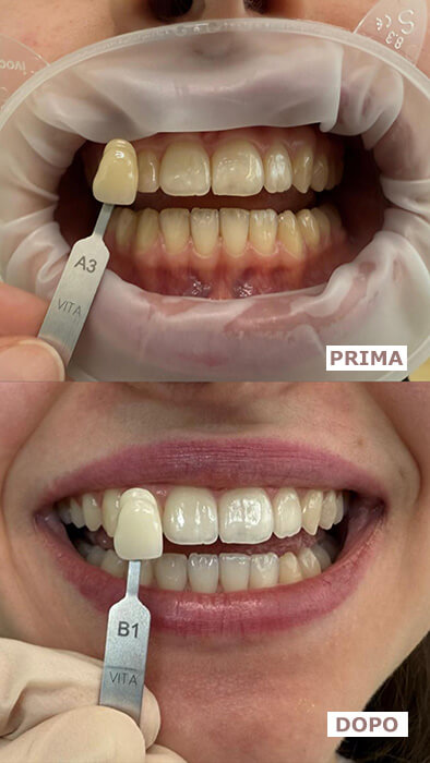 Dental Time Sbiancamento Dentale Professionale. Come scegliere il trattamento giusto e dove farlo