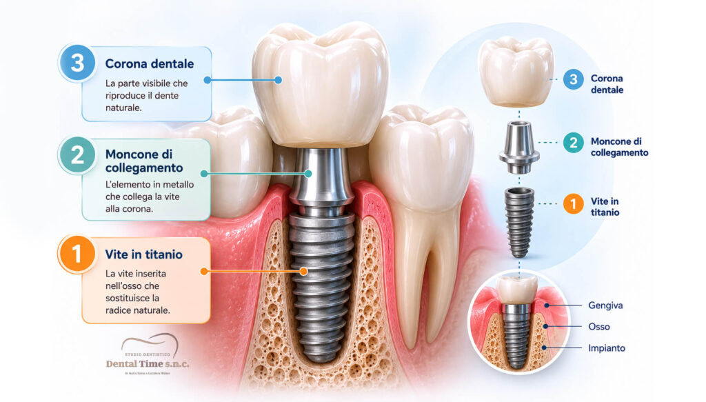 Dental Time Dentista Cesano Maderno Impianto Dentale Guida